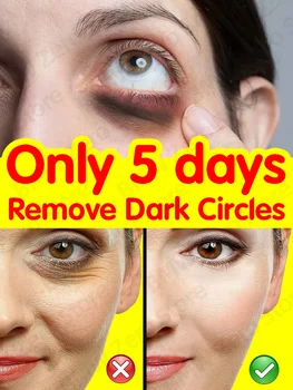 Тъмни кръгове крем и торбички против торбички в очите кръг отстраняване